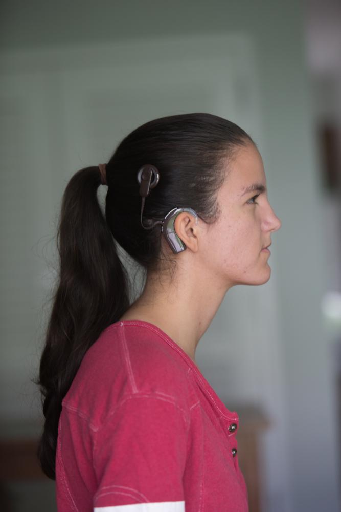 Cochlear Implants And Deaf Identity